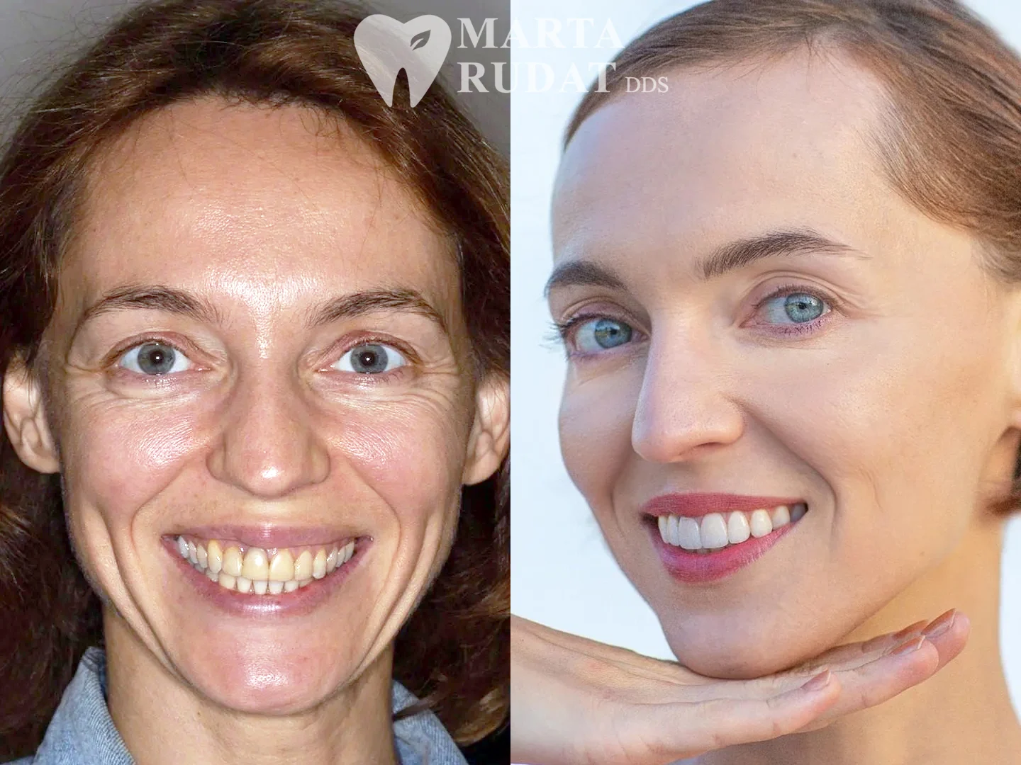 Marta Rudat DDS — Before and after porcelain veneers designed to improve tooth shape, proportion, color and overall smile harmony.